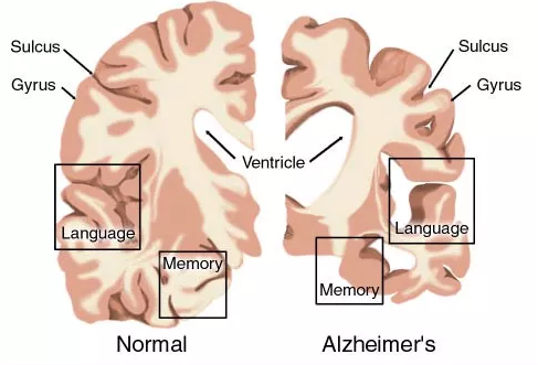 AD药物研发近况：辉瑞、礼来、百健、诺华、强生……