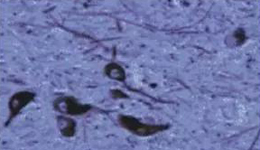 正常人：黑质神经元存在