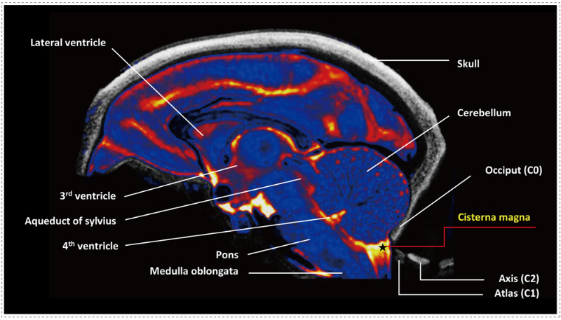 猴脑中幼脑延髓池-(CM)-的定位示意图.jpg